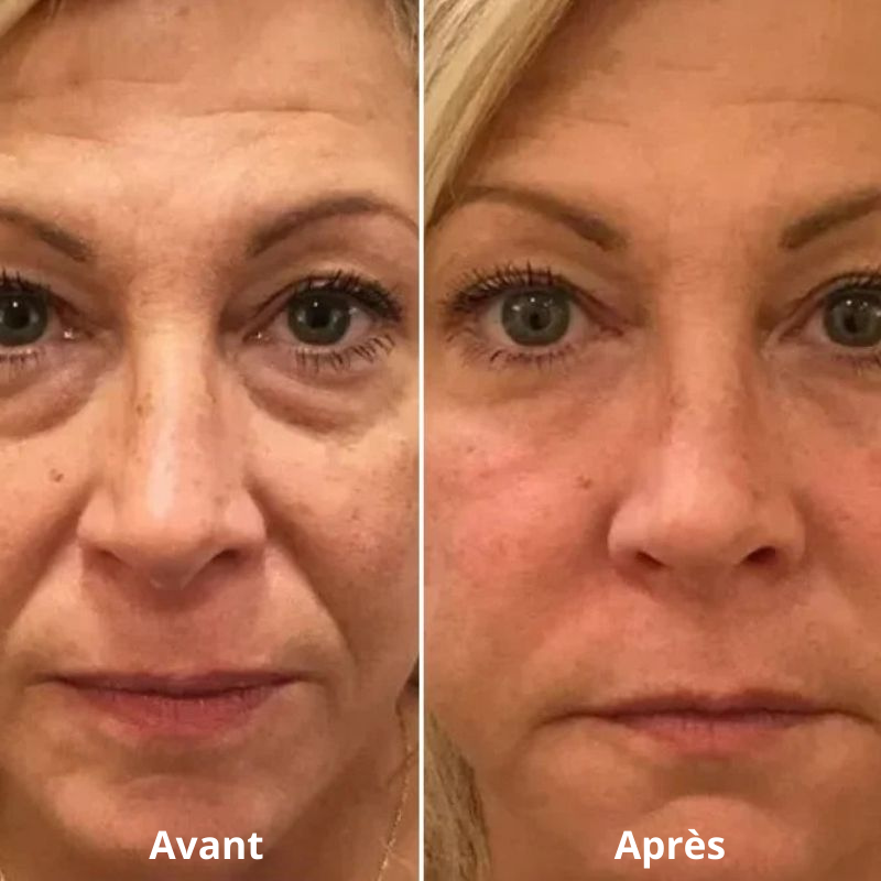 LUMILIFT®  Innovation anti-poches et cernes