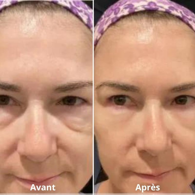 LUMILIFT®  Innovation anti-poches et cernes