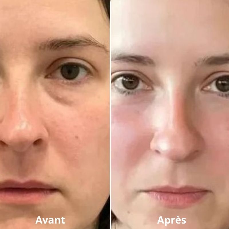 LUMILIFT®  Innovation anti-poches et cernes