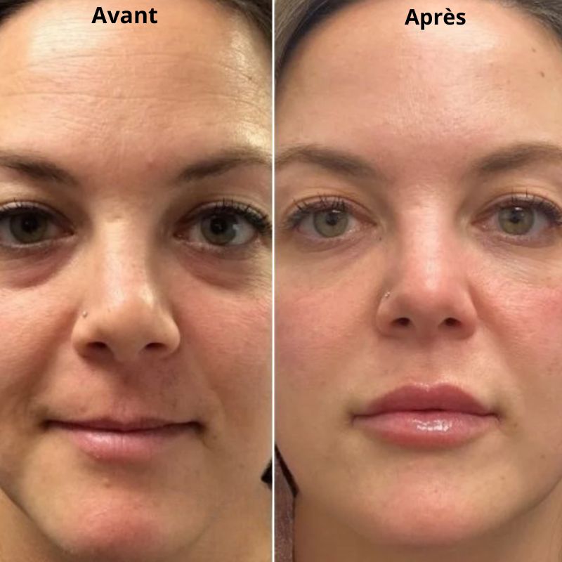 Patchs Hydralift (une paire)