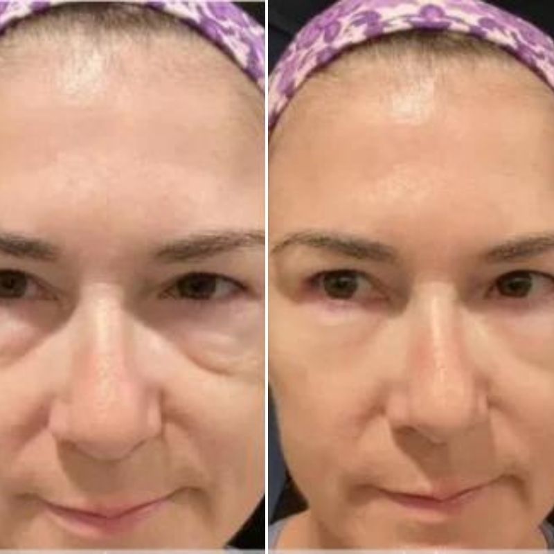 Lot de 1 LUMILIFT® + 1 FLASHLift+ MASQUE