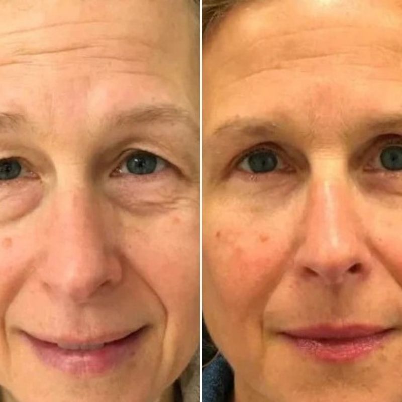 Lot de 1 LUMILIFT® + 1 FLASHLift+ MASQUE