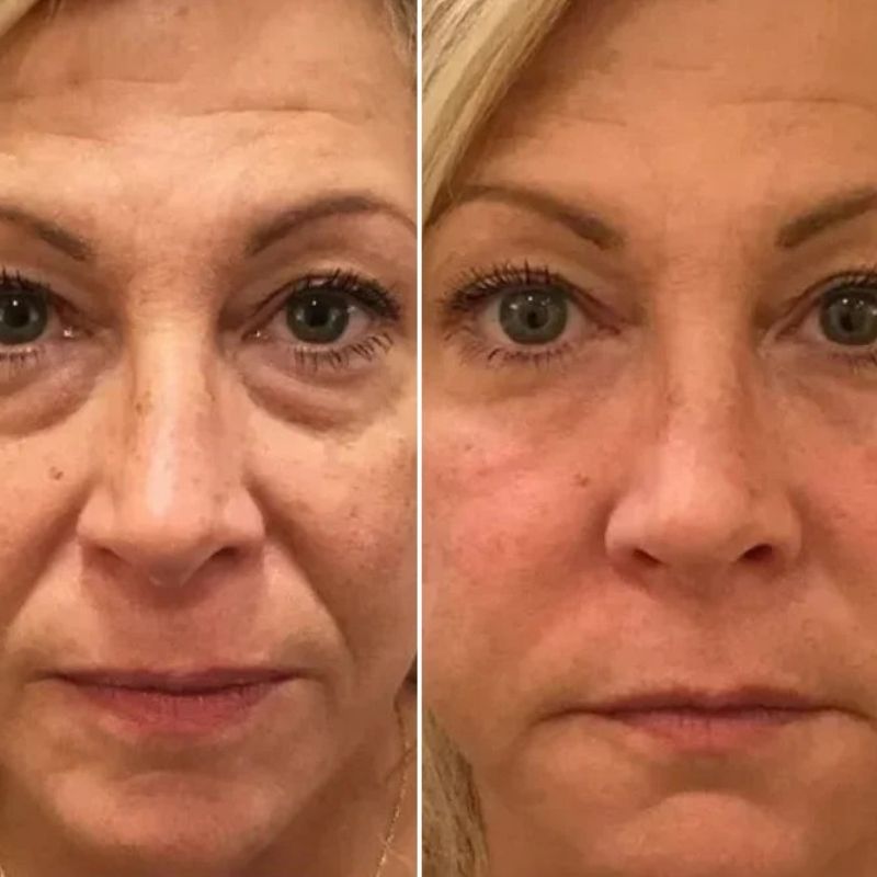 Lot de 1 LUMILIFT® + 1 FLASHLift+ MASQUE