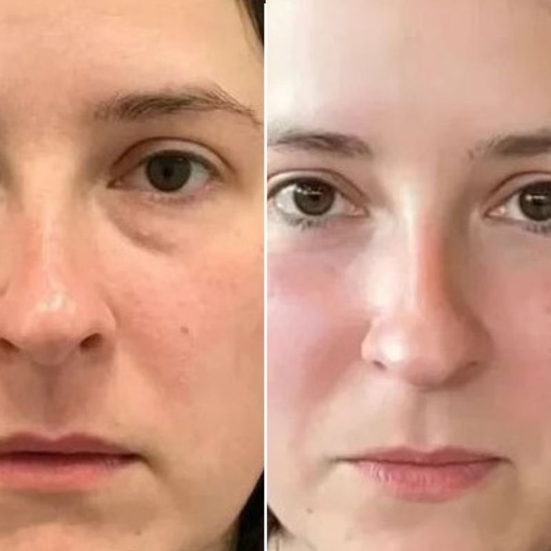 Lot de 1 LUMILIFT® + 1 FLASHLift+ MASQUE
